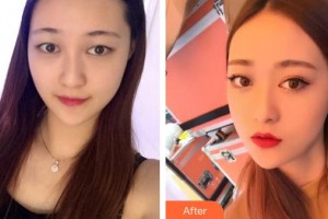 廈門(mén)大學(xué)附屬?gòu)B門(mén)眼科中心醫(yī)院龔頌建整形價(jià)格表附玫瑰花雨的雙眼皮案例展示