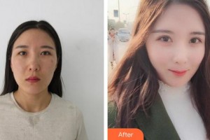 廈門(mén)大學(xué)附屬?gòu)B門(mén)眼科中心醫(yī)院李勇整形價(jià)格表附眼部綜合案例展示