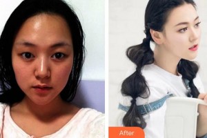 廈門(mén)大學(xué)附屬?gòu)B門(mén)眼科中心醫(yī)院陳惠嬋整形價(jià)格表附雙眼皮案例展示