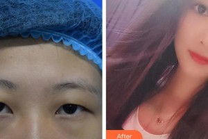 廈門(mén)大學(xué)附屬?gòu)B門(mén)眼科中心醫(yī)院王曉波整形價(jià)格表附眼部手術(shù)案例展示