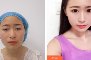 廈門(mén)大學(xué)附屬?gòu)B門(mén)眼科中心醫(yī)院黃艷明整形價(jià)格表附眼部整形案例展示