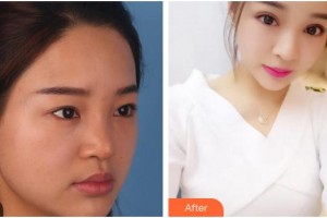 廈門(mén)大學(xué)附屬?gòu)B門(mén)眼科中心醫(yī)院陳燕整形價(jià)格表附全切雙眼皮案例展示