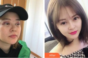 廈門(mén)大學(xué)附屬?gòu)B門(mén)眼科中心醫(yī)院吳東海整形價(jià)格表附胎生隱形雙眼皮修復(fù)案例展示