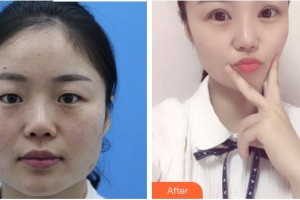 廈門(mén)大學(xué)附屬?gòu)B門(mén)眼科中心醫(yī)院江國(guó)華整形價(jià)格表附一眼愛(ài)上你的雙眼皮案例展示