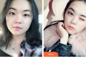 廈門(mén)大學(xué)附屬?gòu)B門(mén)眼科中心醫(yī)院陳亮整形價(jià)格表附眼部整形案例展示