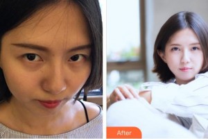 廈門(mén)大學(xué)附屬?gòu)B門(mén)眼科中心醫(yī)院康克明整形價(jià)格表附切開(kāi)雙眼皮案例展示