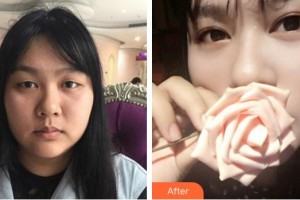 廈門(mén)大學(xué)附屬?gòu)B門(mén)眼科中心醫(yī)院張小虎整形價(jià)格表附切開(kāi)雙眼皮案例展示