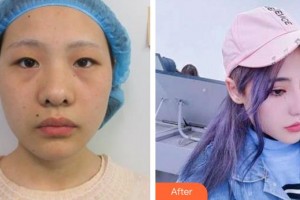 廈門(mén)大學(xué)附屬?gòu)B門(mén)眼科中心醫(yī)院黃維藝整形價(jià)格表附眼部綜合案例展示