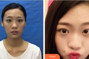 廈門(mén)大學(xué)附屬?gòu)B門(mén)眼科中心醫(yī)院鄧?yán)っ髡蝺r(jià)格表附眼部綜合案例展示