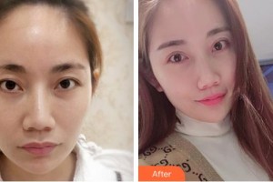 廈門(mén)大學(xué)附屬?gòu)B門(mén)眼科中心醫(yī)院鄭林整形價(jià)格表附定點(diǎn)雙眼皮案例展示