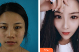 廣州廣大整形美容醫(yī)院秦瑜整形價(jià)格表附鼻部手術(shù)案例展示