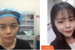 廈門(mén)大學(xué)附屬?gòu)B門(mén)眼科中心醫(yī)院李瑞霞整形價(jià)格表附眼部手術(shù)案例展示