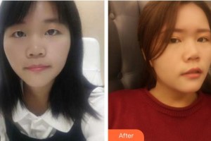 廈門(mén)市第二醫(yī)院美容整形外科中心肖磊整形價(jià)格表附眼睛改變小記錄案例展示