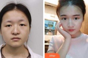 廈門(mén)大學(xué)附屬?gòu)B門(mén)眼科中心醫(yī)院史小玲整形價(jià)格表附切開(kāi)雙眼皮 媚眼如絲案例展示