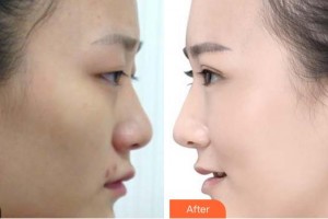 廈門(mén)大學(xué)附屬?gòu)B門(mén)眼科中心醫(yī)院林青鴻整形價(jià)格表附眼部整形案例展示