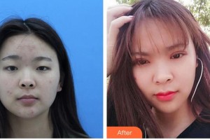 廈門(mén)大學(xué)附屬?gòu)B門(mén)眼科中心醫(yī)院羅向東整形價(jià)格表附切開(kāi)雙眼皮案例展示