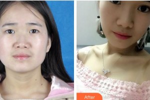 廈門(mén)大學(xué)附屬?gòu)B門(mén)眼科中心醫(yī)院吳媛整形價(jià)格表附雙眼皮案例展示