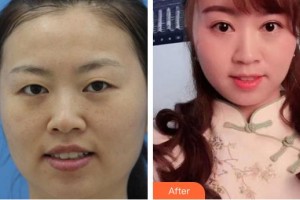 廈門(mén)大學(xué)附屬?gòu)B門(mén)眼科中心醫(yī)院陳彥茹整形價(jià)格表附眼部案例展示