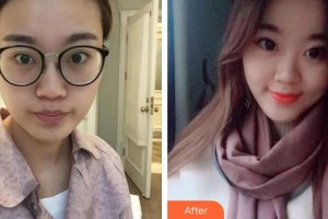 廈門(mén)大學(xué)附屬?gòu)B門(mén)眼科中心醫(yī)院劉今坤住院醫(yī)師整形價(jià)格表附切開(kāi)雙眼皮案例展示