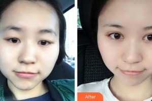 廈門(mén)大學(xué)附屬?gòu)B門(mén)眼科中心醫(yī)院劉名威整形價(jià)格表附眼部整形案例展示