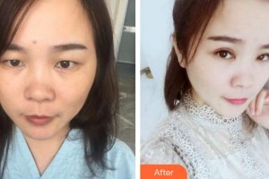 廈門(mén)大學(xué)附屬?gòu)B門(mén)眼科中心醫(yī)院陳龍龍住院醫(yī)師整形價(jià)格表附眼部整形案例展示