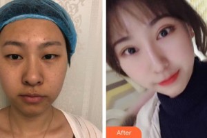 廈門(mén)大學(xué)附屬?gòu)B門(mén)眼科中心醫(yī)院況坤整形價(jià)格表附雙眼皮+內(nèi)外眼角案例展示