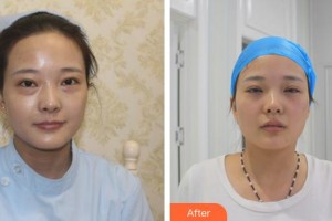 廈門大學(xué)附屬廈門眼科中心醫(yī)院吳錦熙住院醫(yī)師整形價(jià)格表附不開刀祛眼袋案例展示