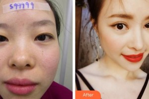 廈門大學(xué)附屬廈門眼科中心醫(yī)院潘桔昕住院醫(yī)師整形價(jià)格表附帕克雙眼皮+開內(nèi)眼角案例展示