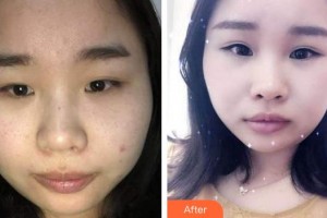 廈門科宏眼科醫(yī)院洪榮照整形價(jià)格表附雙眼皮經(jīng)歷案例展示