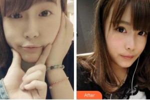 廈門大學(xué)附屬廈門眼科中心醫(yī)院雷雨住院醫(yī)師整形價(jià)格表附切開雙眼皮案例展示