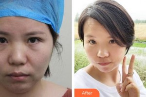 廈門科宏眼科醫(yī)院郝鳳珍整形價(jià)格表附不開刀去眼袋案例展示