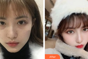 廣州鴻嘉怡美微整形醫(yī)院姚絢整形價(jià)格表附熱瑪吉案例展示