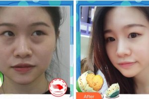 廈門科宏眼科醫(yī)院周孟德整形價(jià)格表附微創(chuàng)祛眼袋案例展示