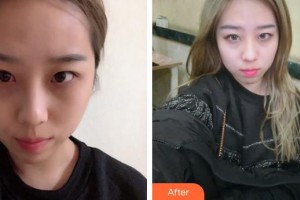 廈門科宏眼科醫(yī)院洪艷整形價(jià)格表附不開刀祛眼袋案例展示