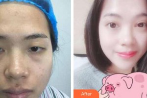 廈門科宏眼科醫(yī)院楊鵬飛整形價(jià)格表附切開雙眼皮案例展示