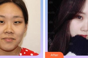 廈門科宏眼科醫(yī)院許丁木整形價(jià)格表附雙眼皮+開內(nèi)眼角案例展示