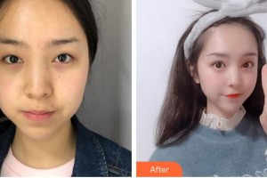 廈門市海滄醫(yī)院眼科林毓妮整形價(jià)格表附眼部手術(shù)案例展示