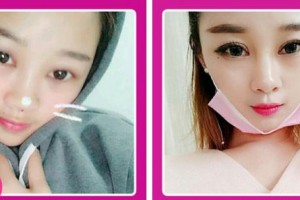 廈門市海滄醫(yī)院眼科王紹鋒整形價(jià)格表附眼部綜合案例展示