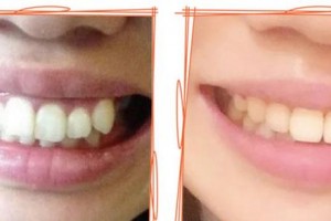 廈門醫(yī)學(xué)院附屬口腔醫(yī)院史建陸整形價(jià)格表附牙齒陶瓷矯正案例展示