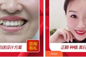 廈門卓爾口腔門診部蘇煉強(qiáng)整形價(jià)格表附隱形矯正案例展示