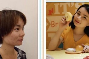 廈門醫(yī)學(xué)院附屬口腔醫(yī)院黃文霞整形價(jià)格表附全隱形牙齒矯正案例展示