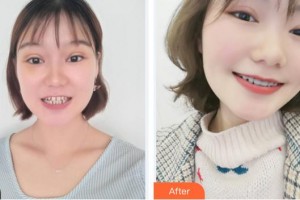 廈門鉑菲特口腔門診部劉保留整形價(jià)格表附牙齒矯正案例展示