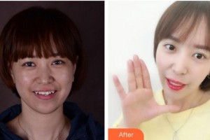 廈門鉑菲特口腔門診部王鈺姬整形價(jià)格表附隱形矯正案例展示