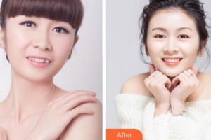 廈門峰煜口腔門診部沈賢生整形價(jià)格表附隱形托槽矯正案例展示