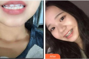 廈門現(xiàn)代口腔門診部楊立明整形價(jià)格表附金屬托槽矯正案例展示