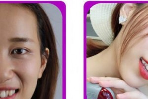 廈門峰煜口腔門診部王春林整形價(jià)格表附隱形矯正案例展示