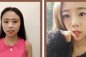 廈門麥芽口腔醫(yī)院馬紅梅整形價(jià)格表附隱形托槽矯正案例展示