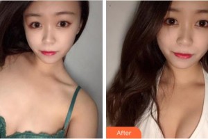 莆田海峽整形美容醫(yī)院沈文鑫整形價(jià)格表附濃縮豐胸真實(shí)案例展示