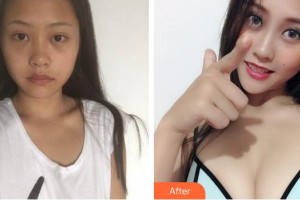 莆田海峽整形美容醫(yī)院洪潤其整形價(jià)格表附假體隆胸日記案例展示