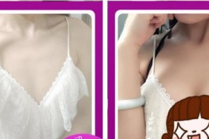 莆田海峽整形美容醫(yī)院南相載整形價(jià)格表附深V動(dòng)感豐胸案例展示